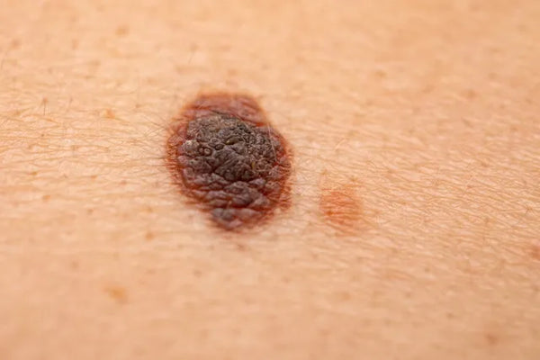 Dark Spots
